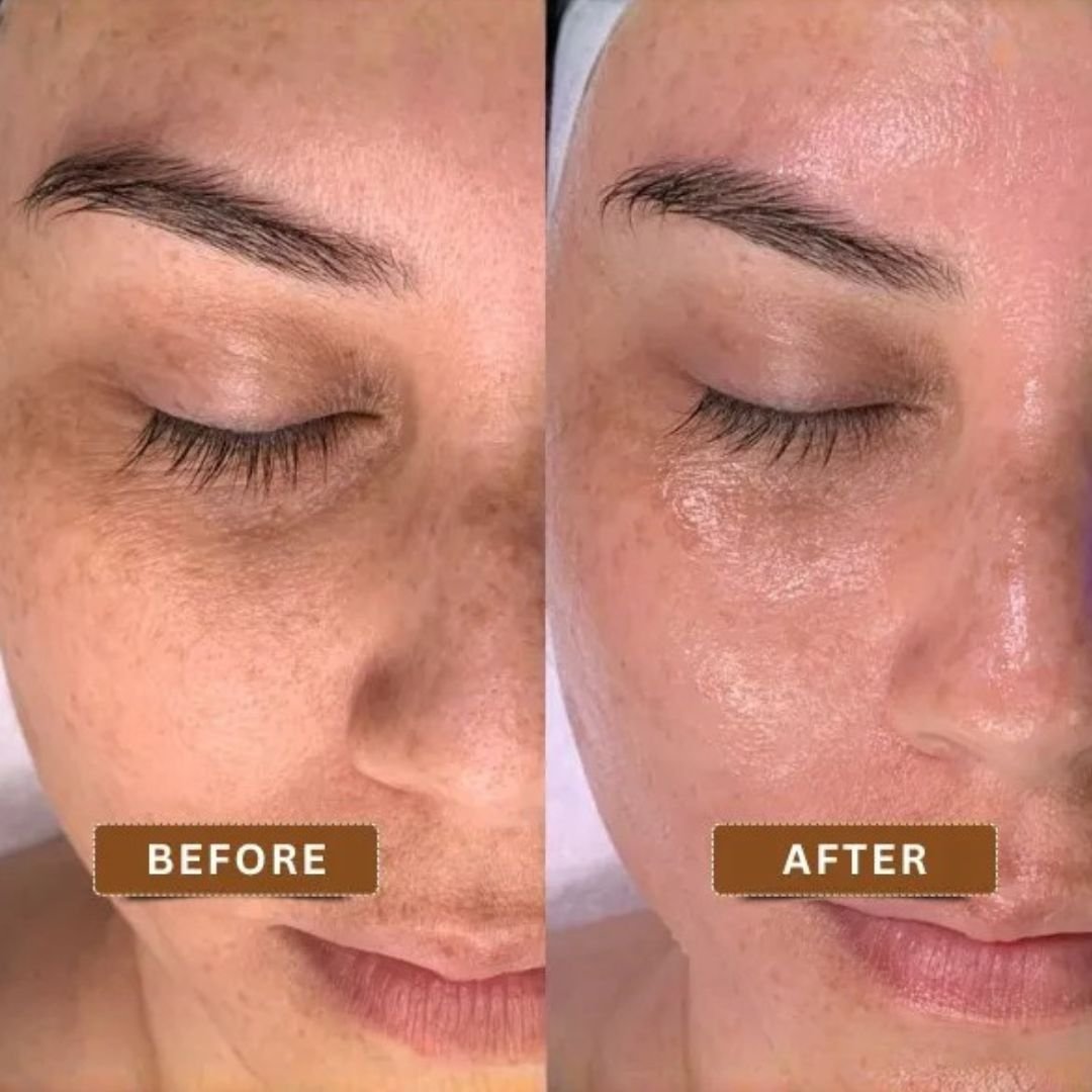 HydraFacial Before and After Glow