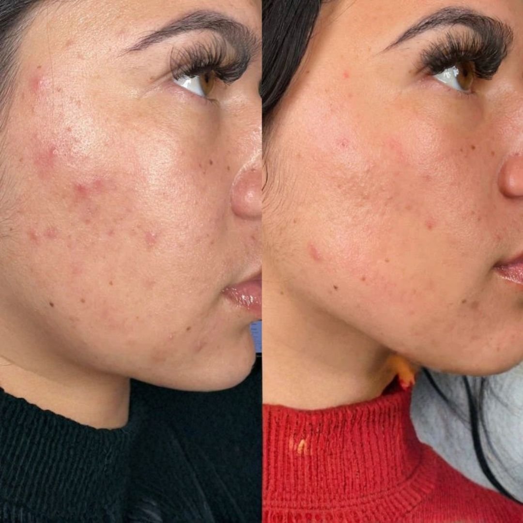 HydraFacial Process